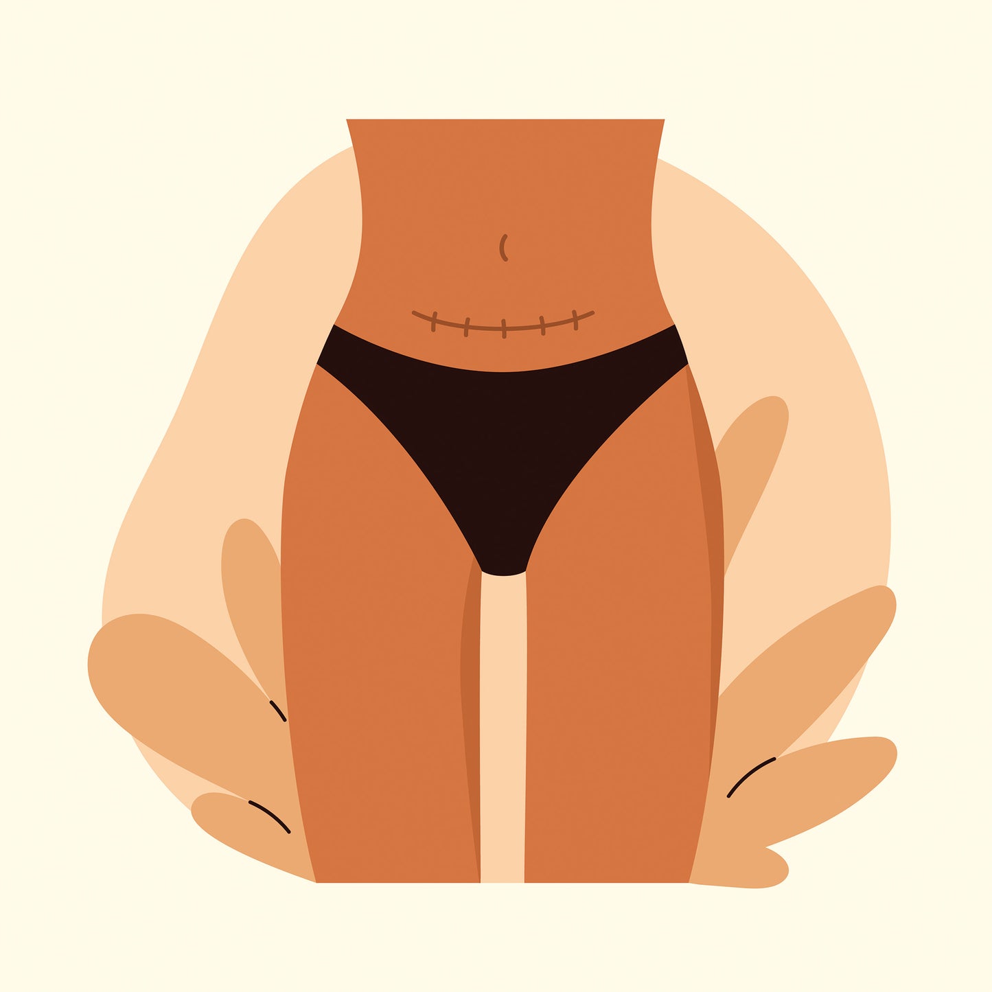 Hypnobirthing For Caesarean Birth